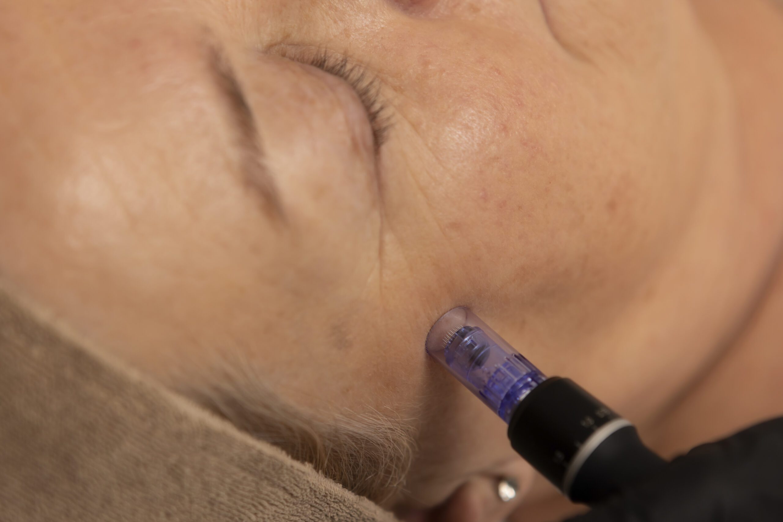 Microneedling met de Dermapen voor littekens, rimpels en striae