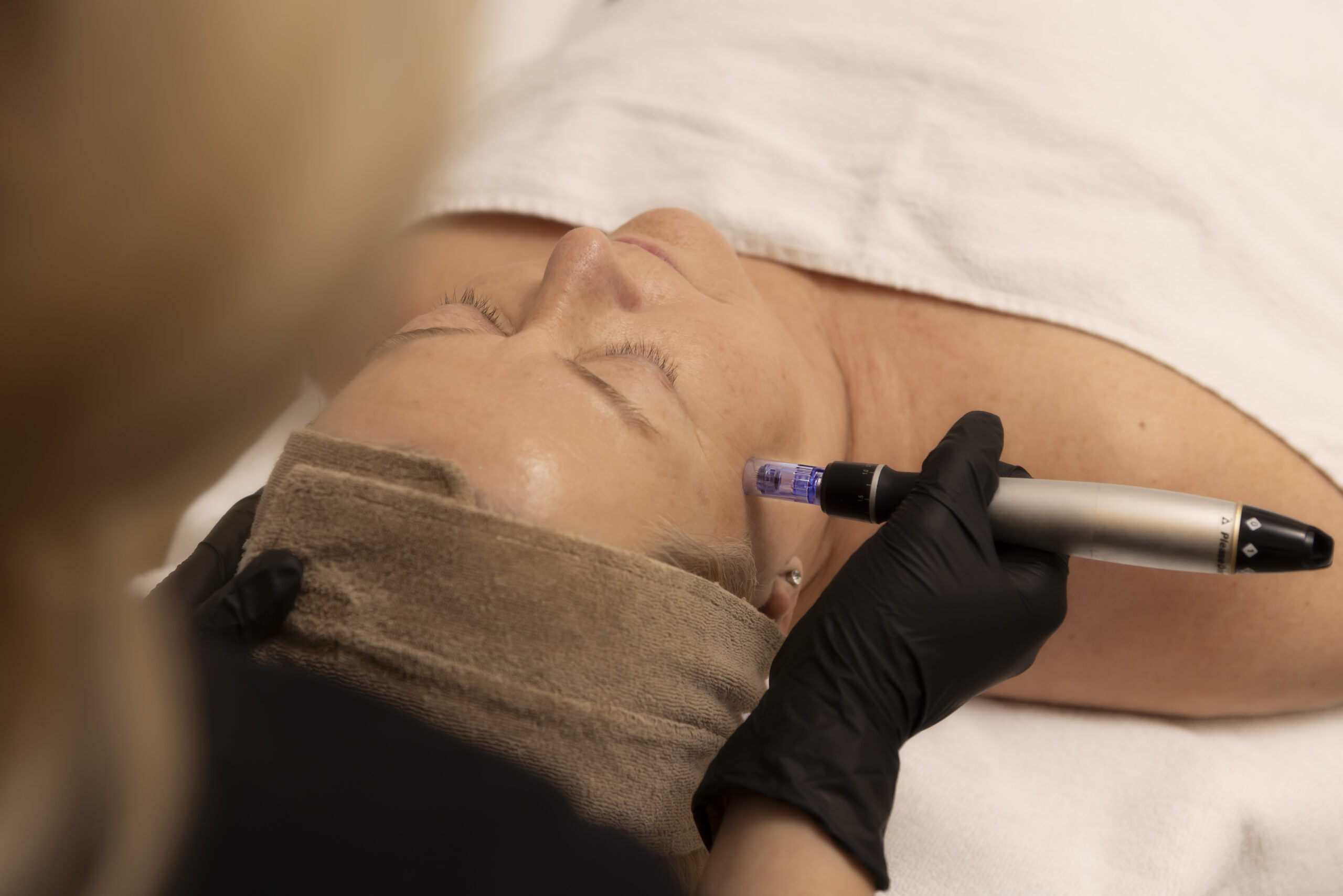Microneedling in Barendrecht met de Dermapen bij SKIN INSTITUTE